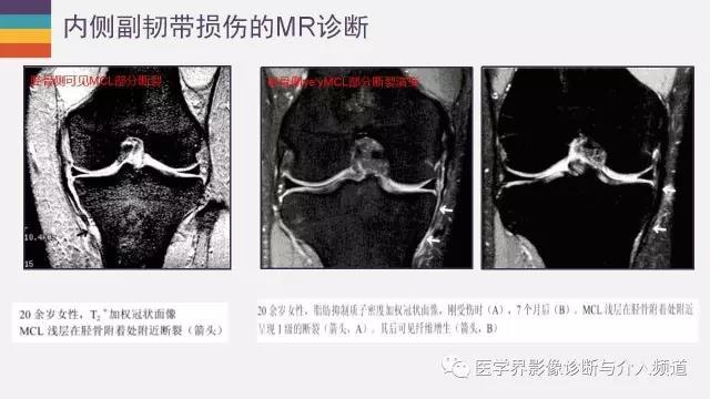 檢查技術韌帶損傷膝關節內側副韌帶的磁共振檢查