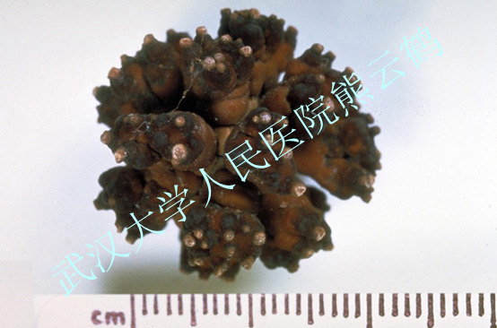calcium_oxalate_monohydrate_kidney_stone-113.jpg