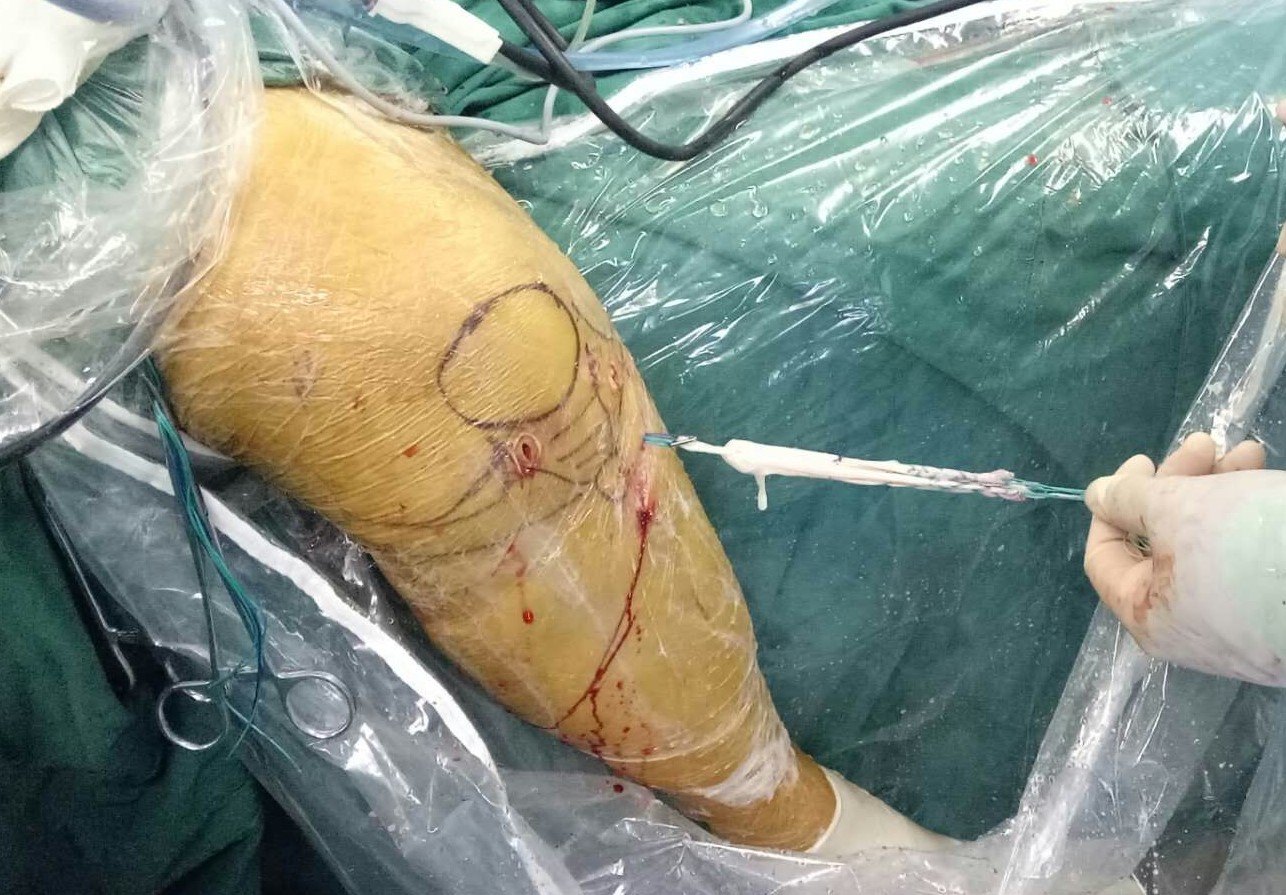 为什么受伤的总是你?膝关节前交叉韧带(ACL)