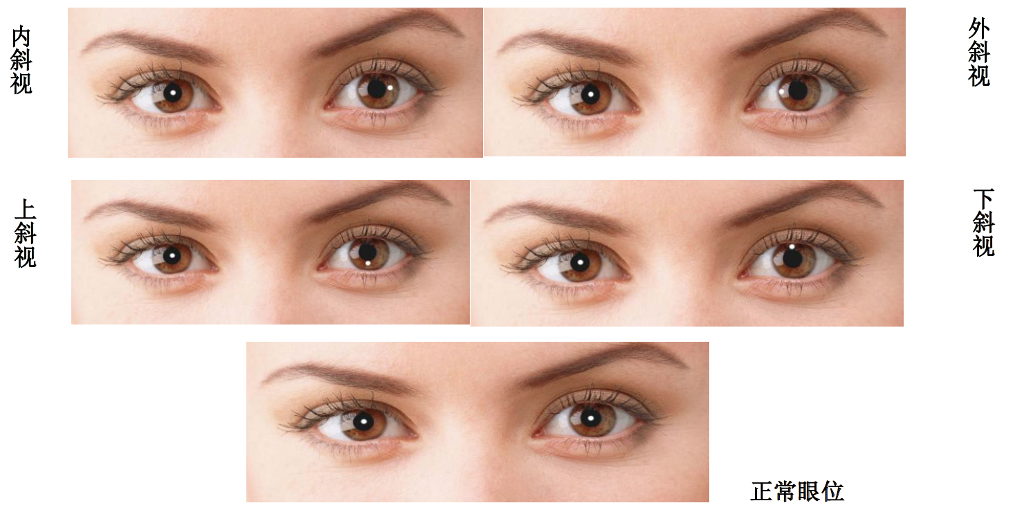 这里给大家安利一个自检是否 斜视 的小技能——角膜映光法:在据被