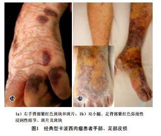 卡波西肉瘤是什么样子的 - 好大夫在线