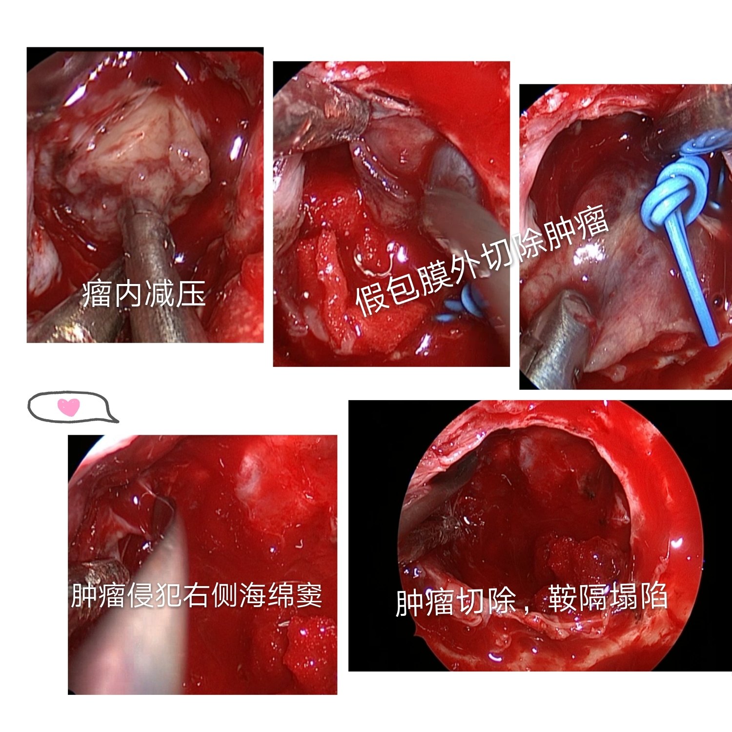 治疗垂体腺瘤,内镜手术更有优势_垂体瘤_手术_治疗方式 - 好大夫在线