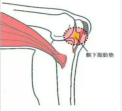 髌下脂肪垫损害 