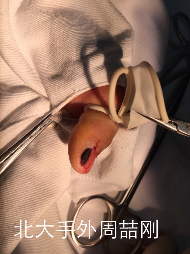 甲母痣手术图片图片