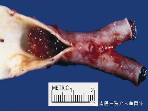 动脉栓塞:风湿性心脏病继发房颤合并左心耳附壁血栓患者不能