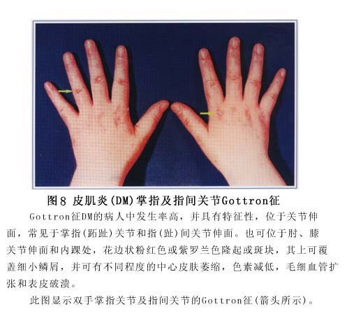 的紫红色浮肿性斑,gottron氏征和甲根皱襞僵直扩张性毛细血管性红斑