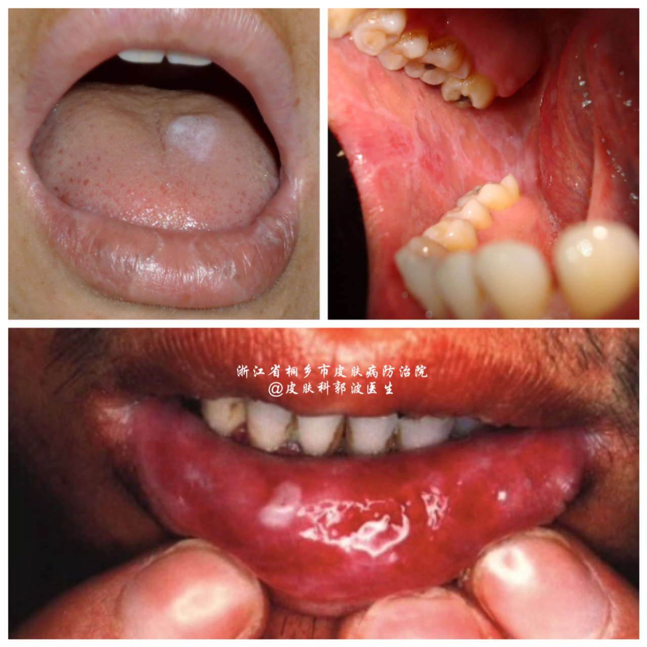 扁平苔藓一种被忽视的常见病