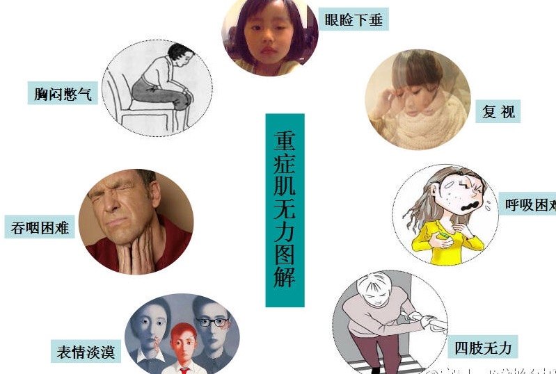 重症肌无力 Mg 病人治疗原则 附图片 重症肌无力 重症肌无力疾病介绍 好大夫在线