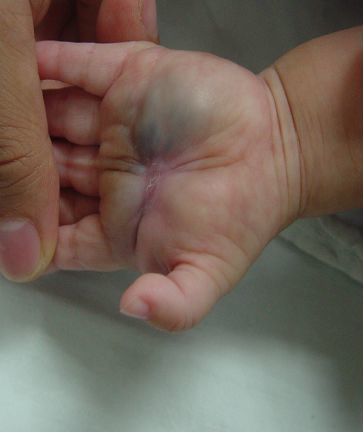 手指静脉血管瘤图片