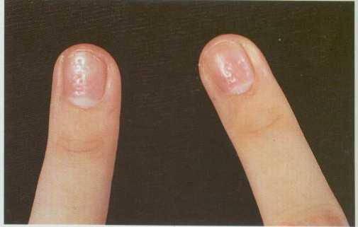 或疼痛,刮除鳞屑会出现针尖样出血点,伴有束状发和顶针样改变的指甲