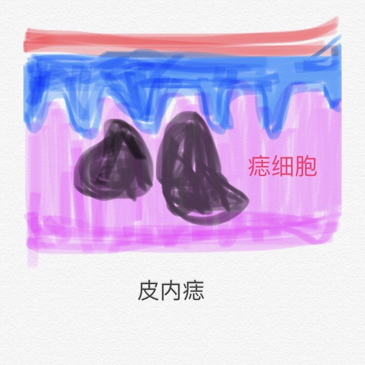 激光去痣还是手术切痣,该如何选择?