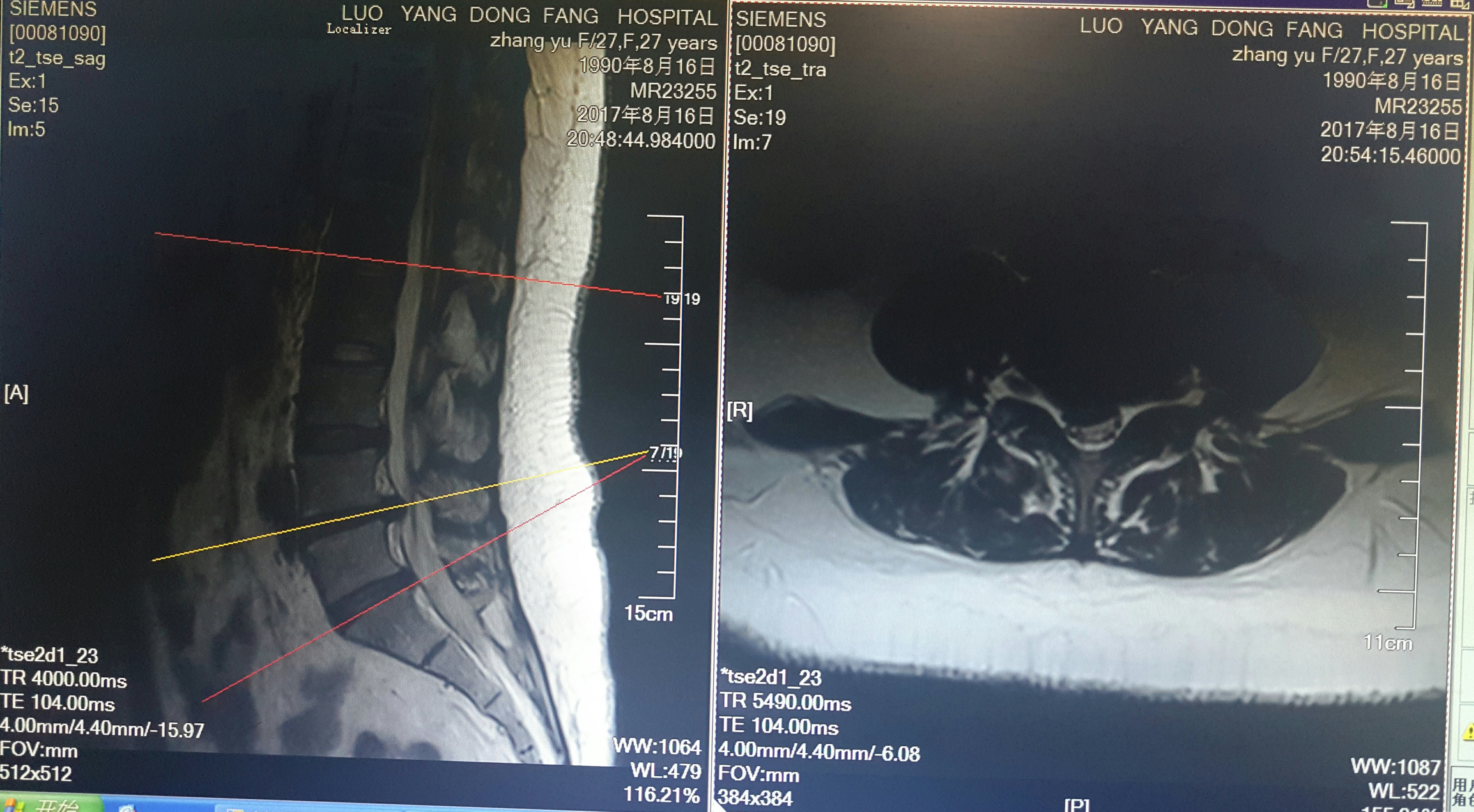 脊柱内镜翻修腰椎间盘突出症胶原酶溶核术后复