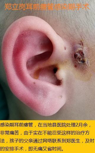 感染期耳前瘘管手术第34湖南李永州李
