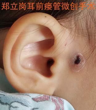 双侧先天性耳前瘘管感染期手术第49广东佛山顺德胡