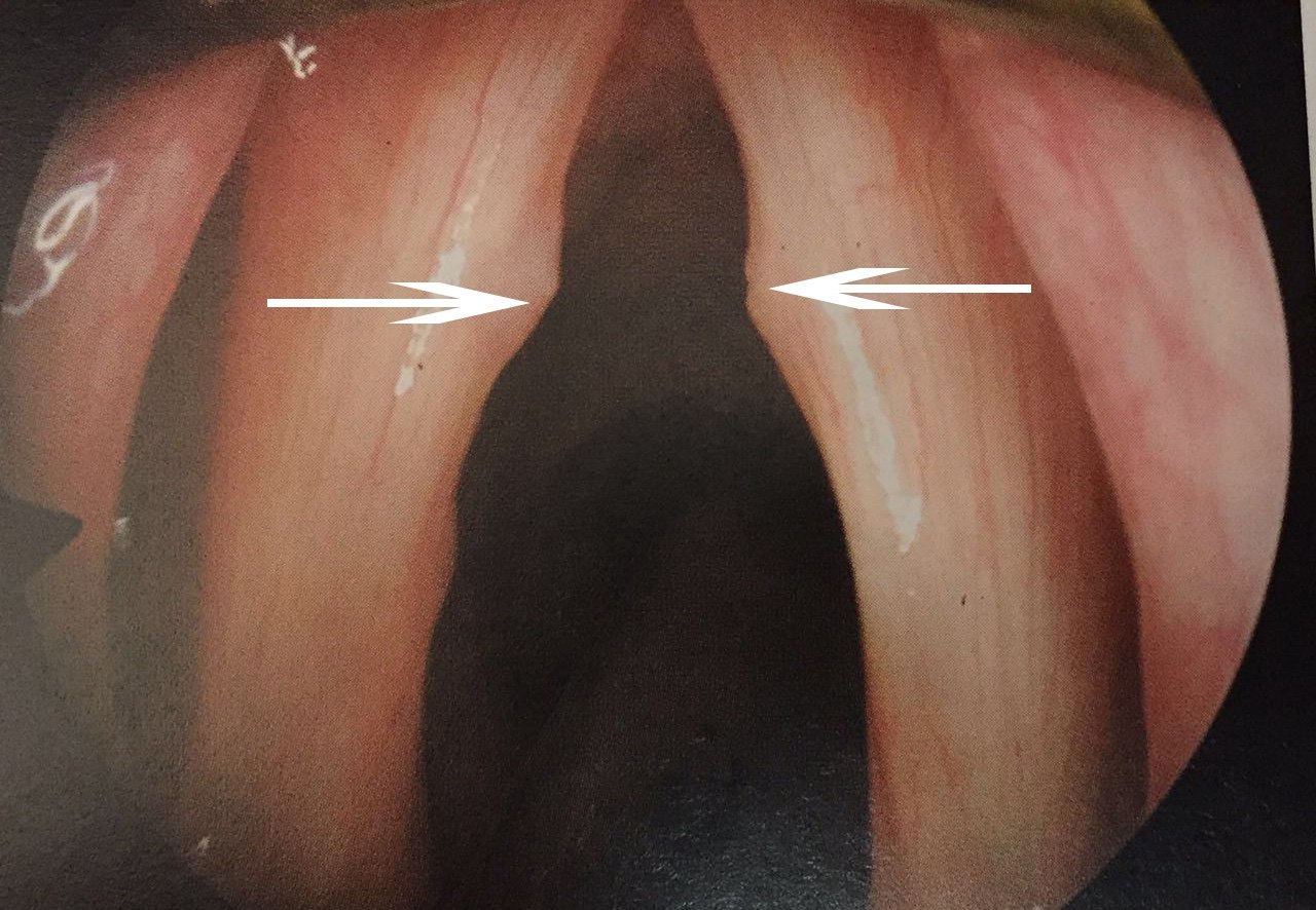 喉镜正常图片图片