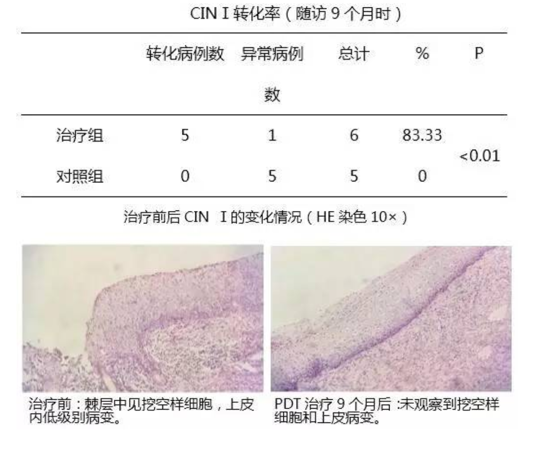 宫颈高危HPV感染无疣体是否需要光动力治疗