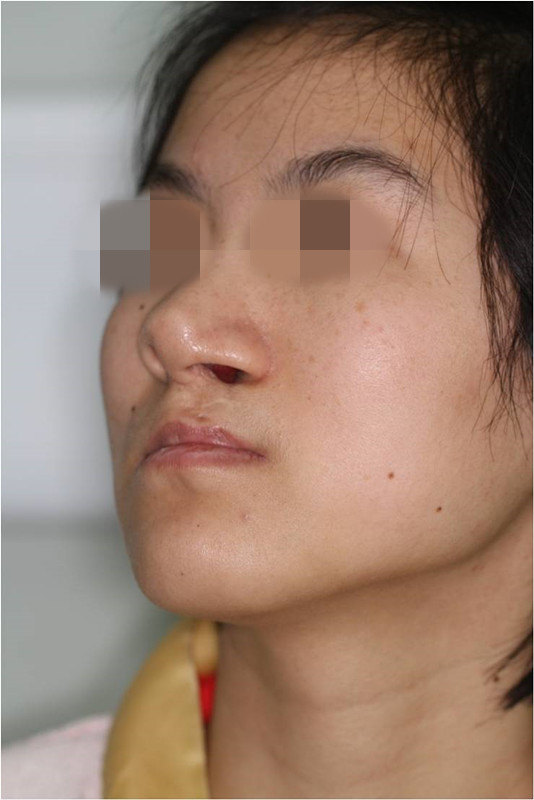 唇裂鼻畸形术前术后四面观对比效果图 