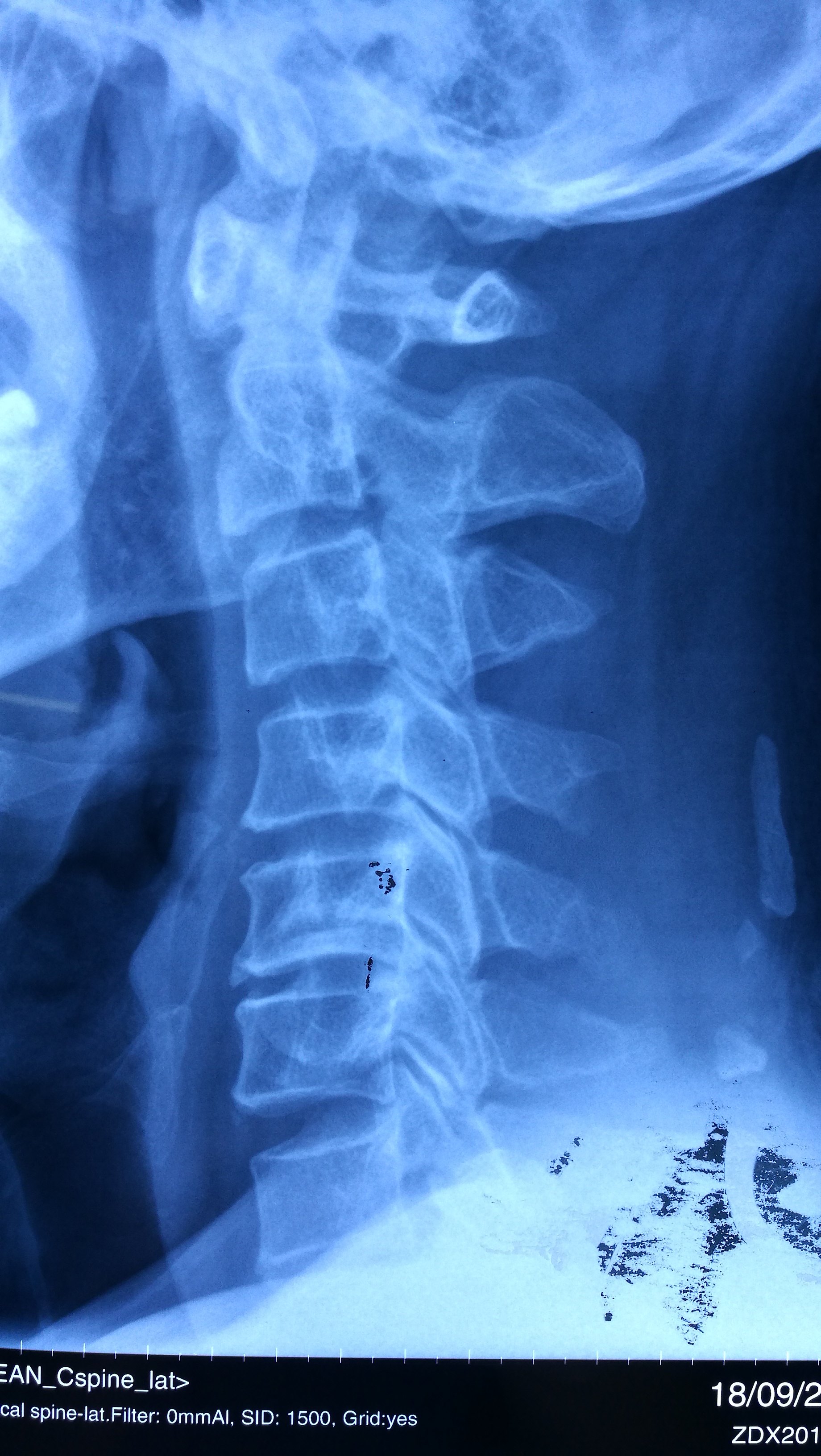 后路杂交手术除颈椎顽疾 - 好大夫在线