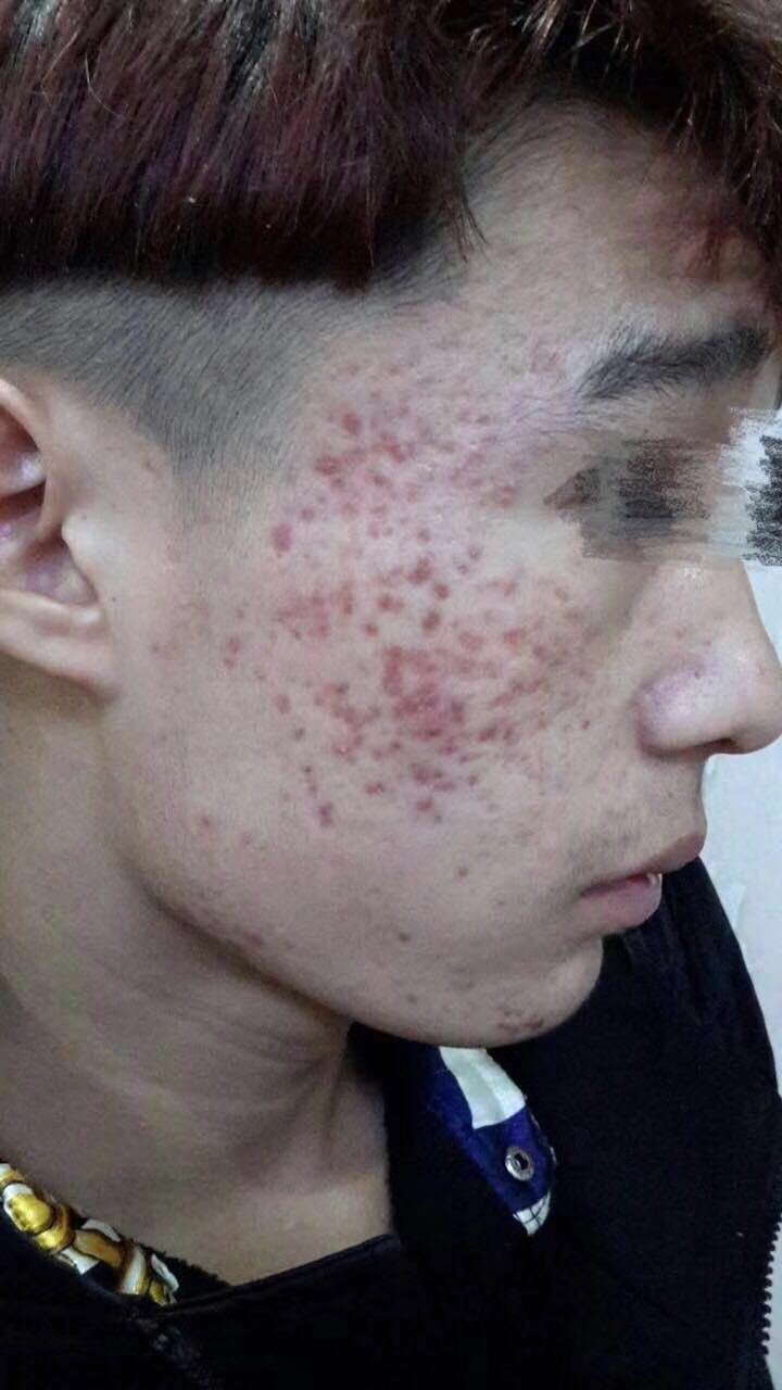 痤疮分级是痤疮治疗及疗效评价的重要依据. - 好大夫在线