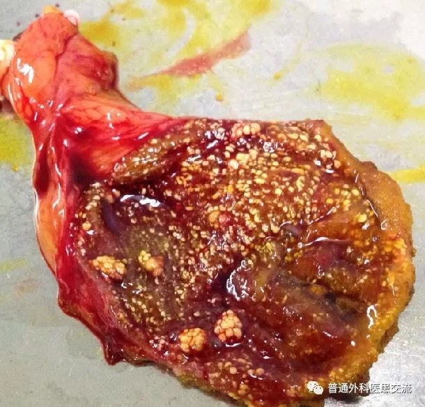 胆囊息肉需要手术吗