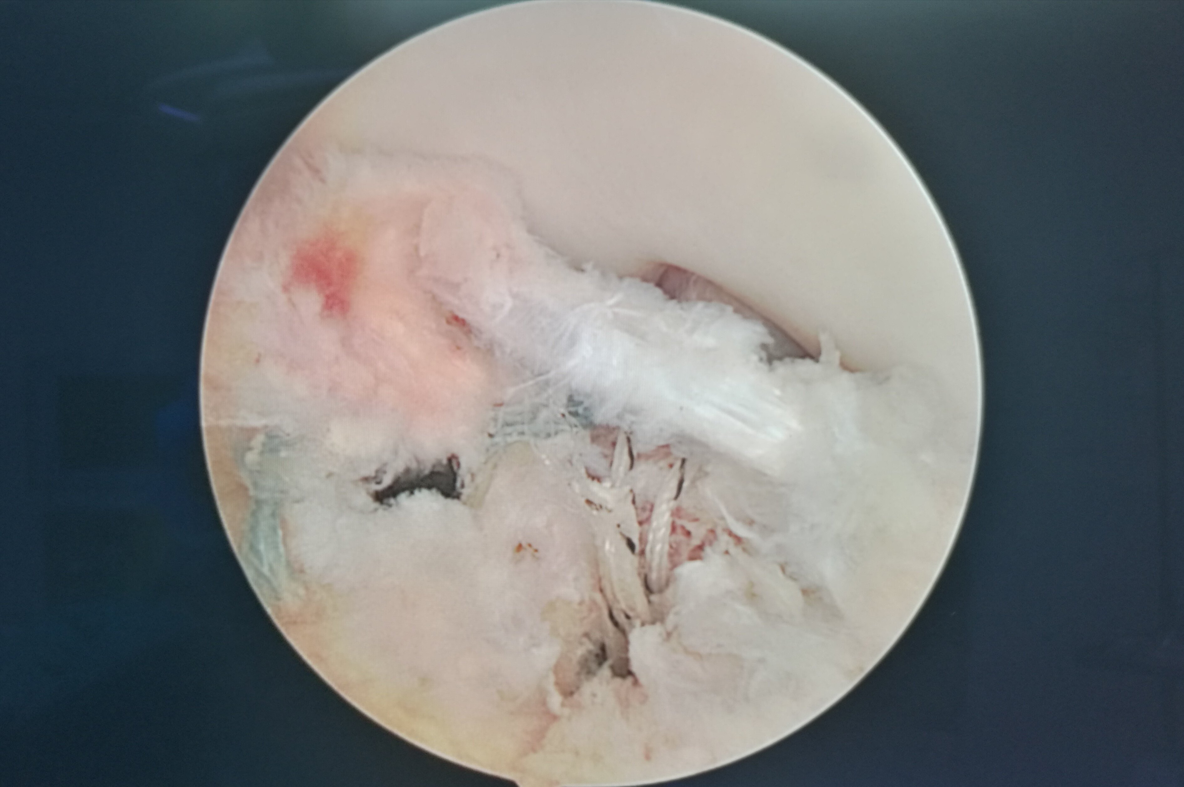 前交叉(十字)韧带撕脱骨折(髁间嵴)精彩手术 - 好大夫在线