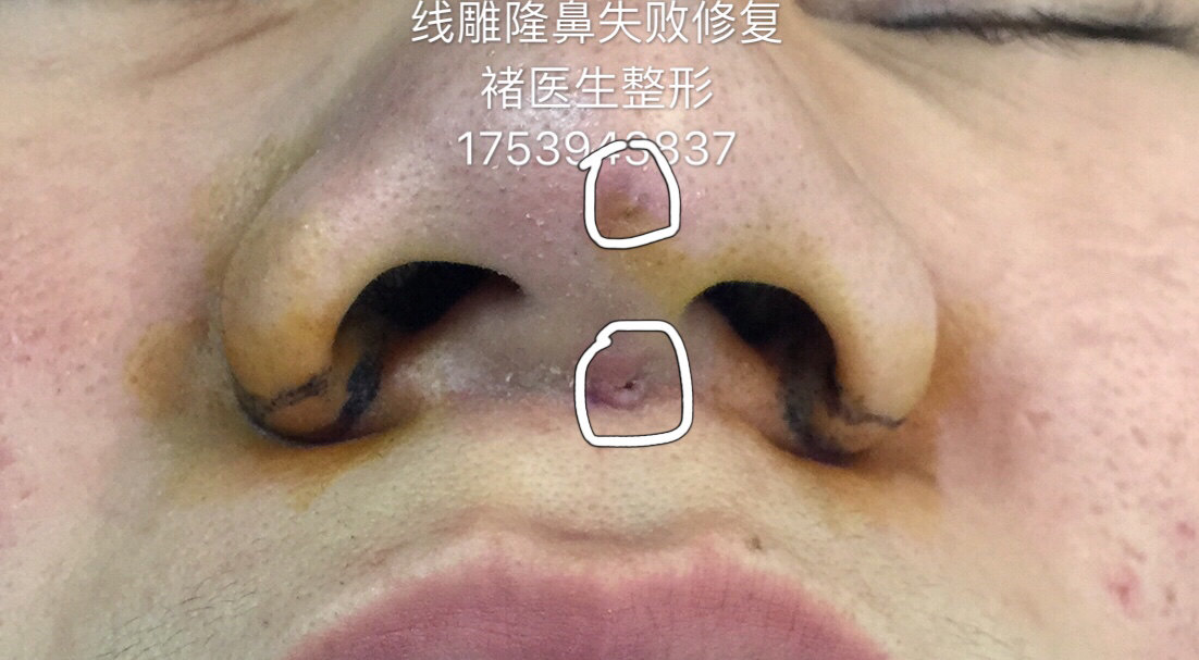 玻尿酸隆鼻失败的患者做线材和玻尿酸取出手术,隆鼻后一个半月了,鼻尖