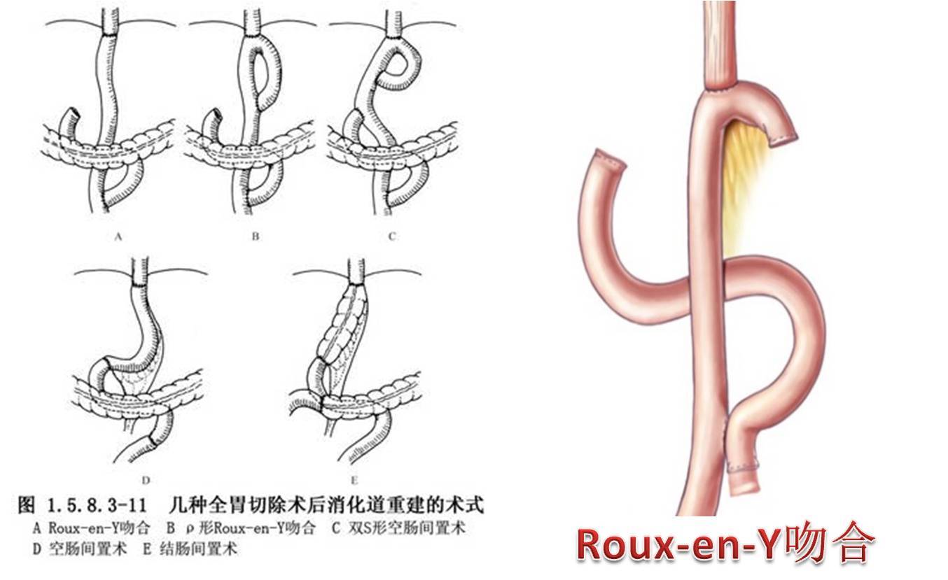 胃切除手术方式图片图片