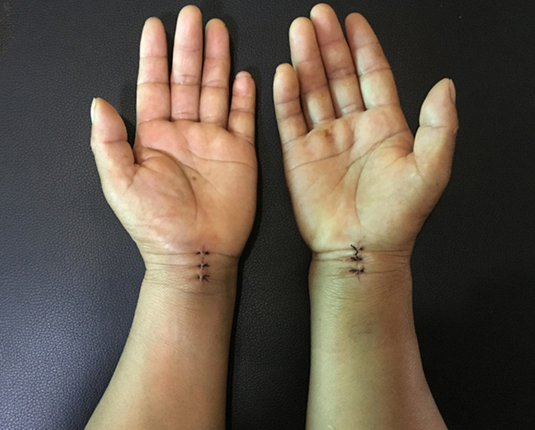 4 患者潘某,女性,52岁,腕管综合征多年,双侧鱼际肌萎缩,手指麻木无力