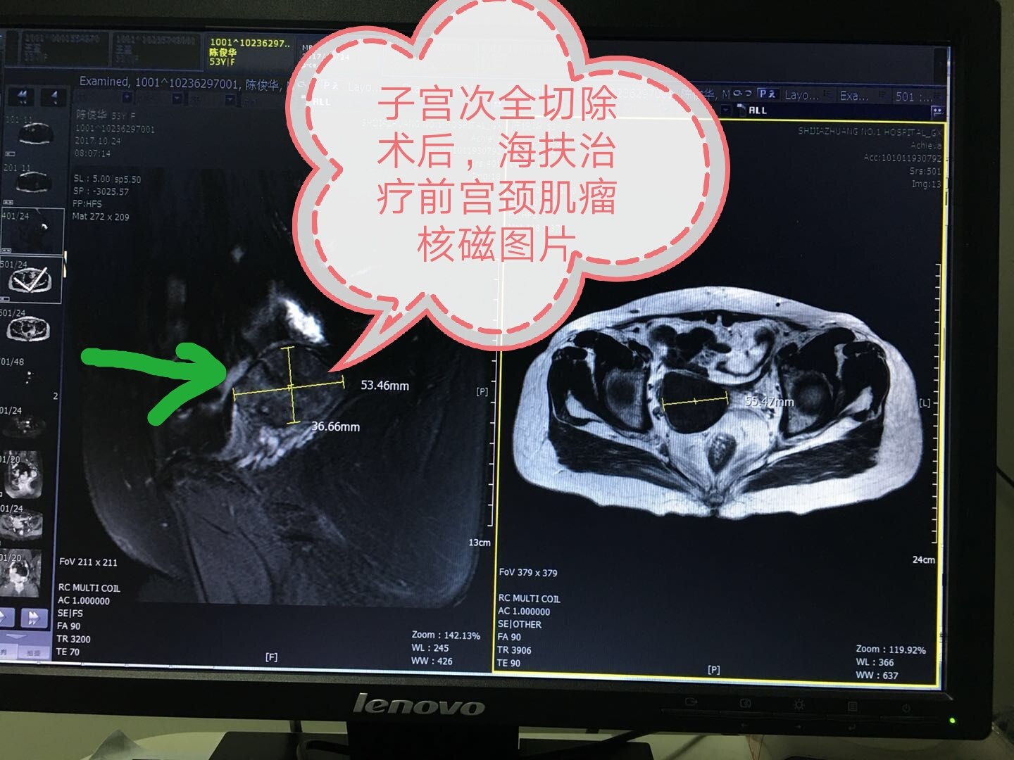 海扶病例分享:子宫次全切除术后宫颈肌瘤海扶消融治疗 - 好大夫在线