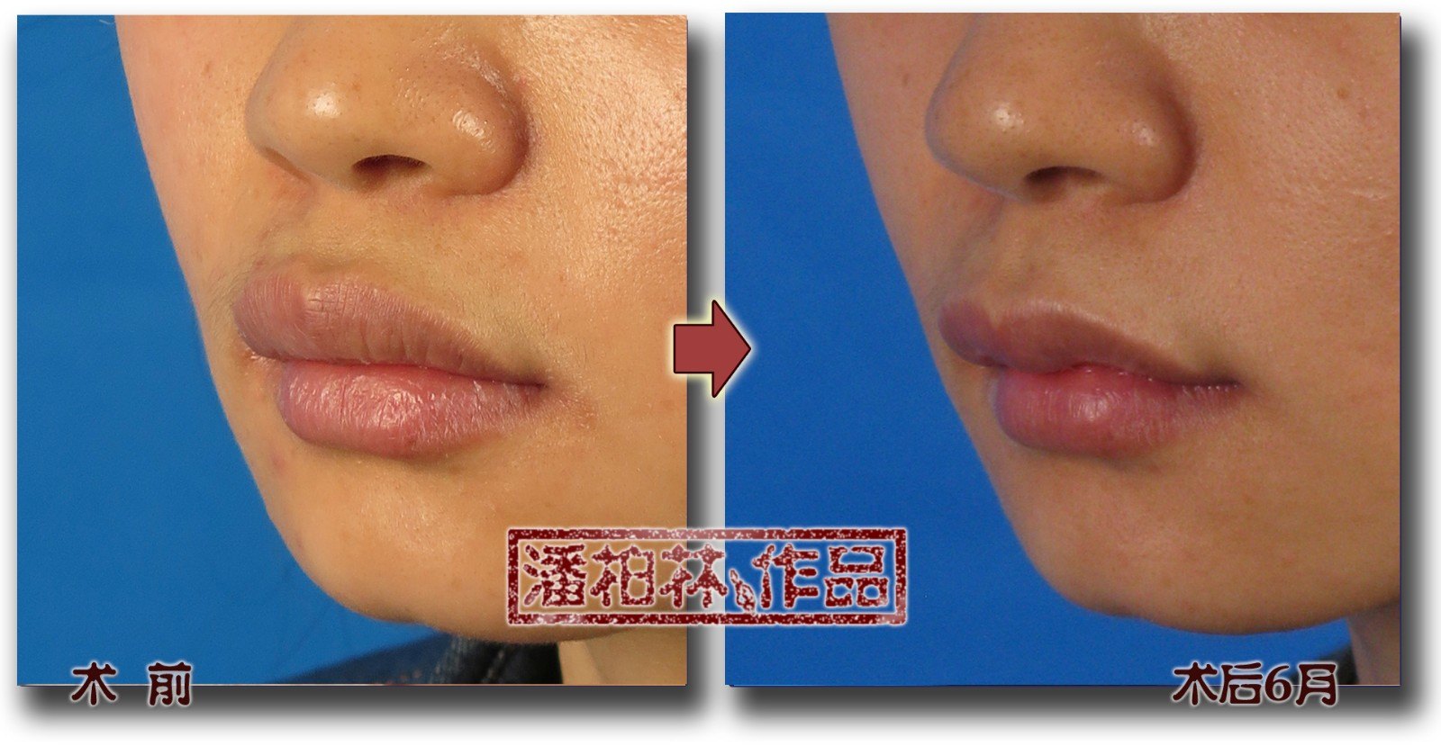 上唇唇形综合整形(m唇成形/Ω唇成形)