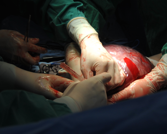 肿瘤放血,减少体积从左外叶上切除肿瘤手术过程小结61术中发现肿瘤