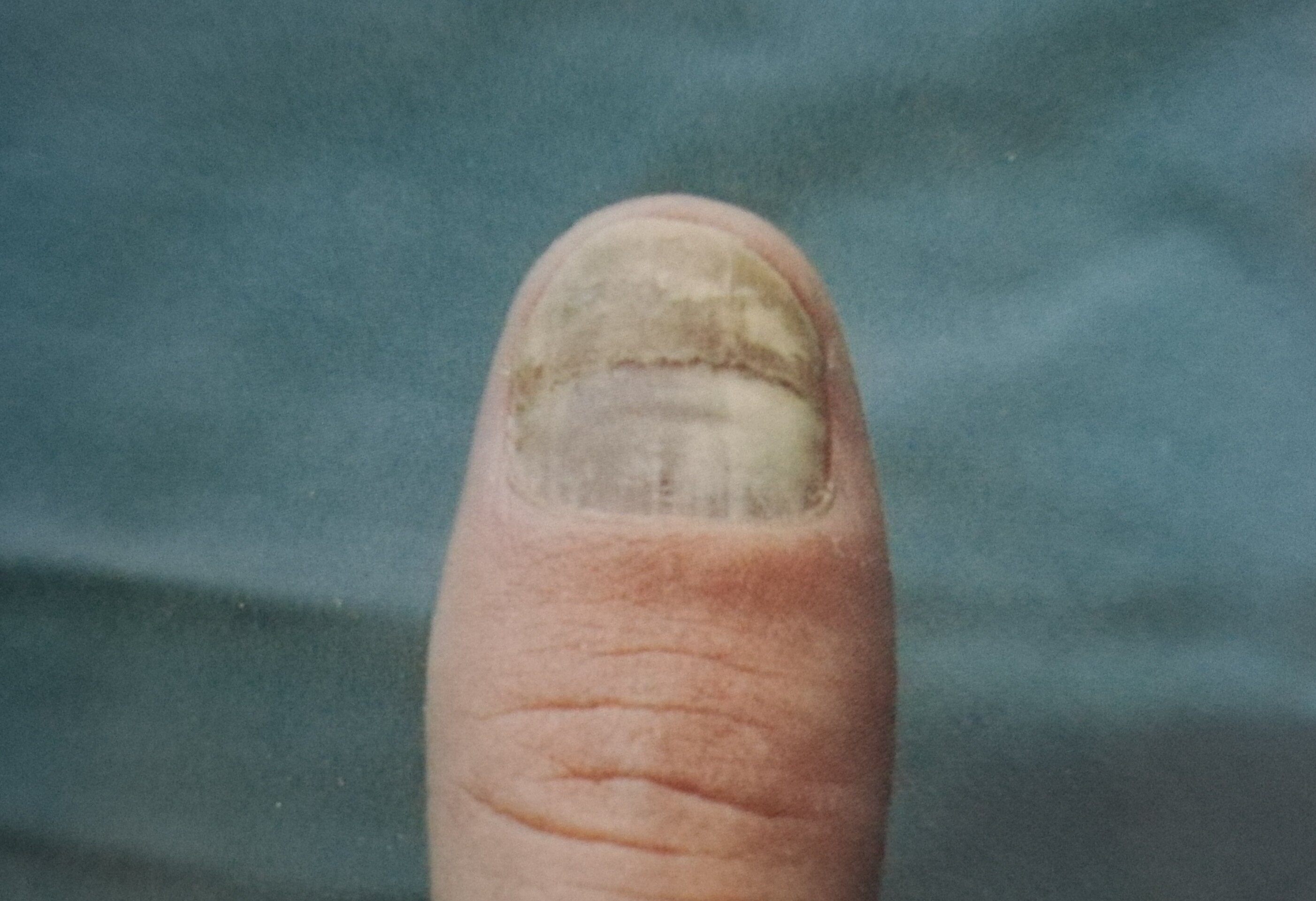 初期灰指甲的图片_早期的灰指甲症状图片表现_灰指甲初期症状图片