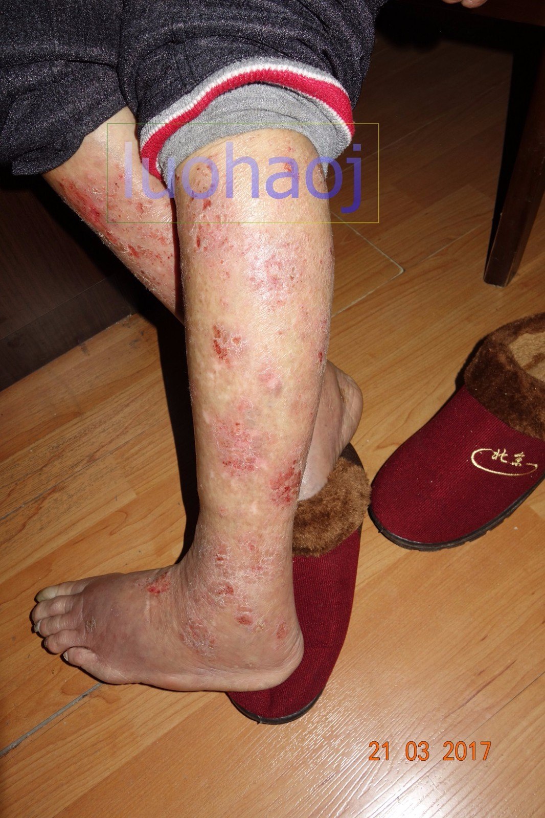 下肢顽固性湿疹伴溃疡案例 