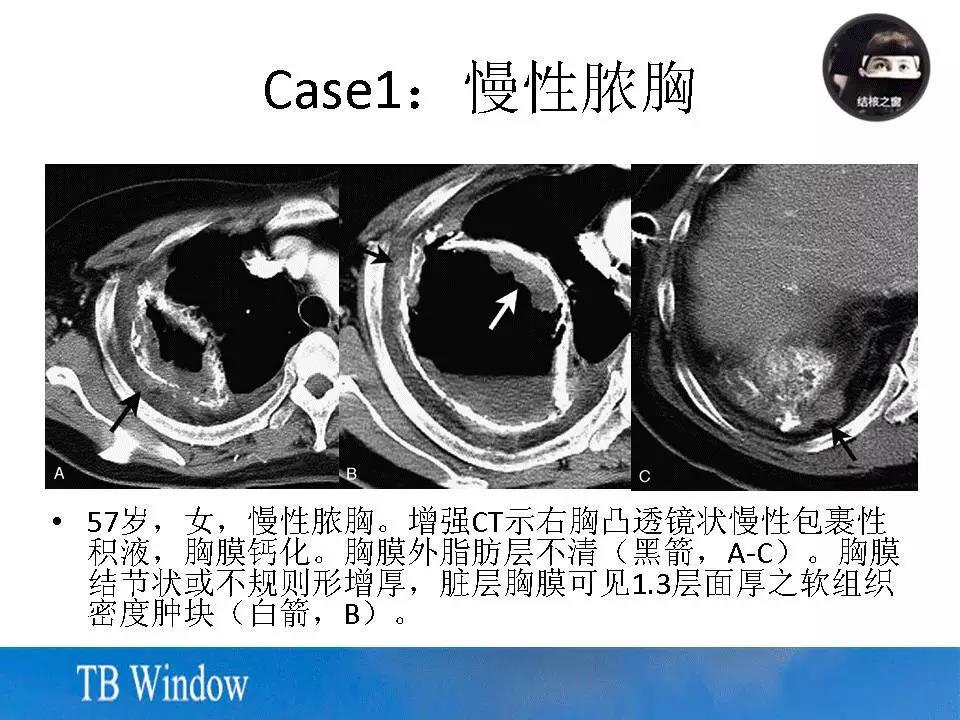 慢性脓胸相关性恶性肿瘤的影像学表现