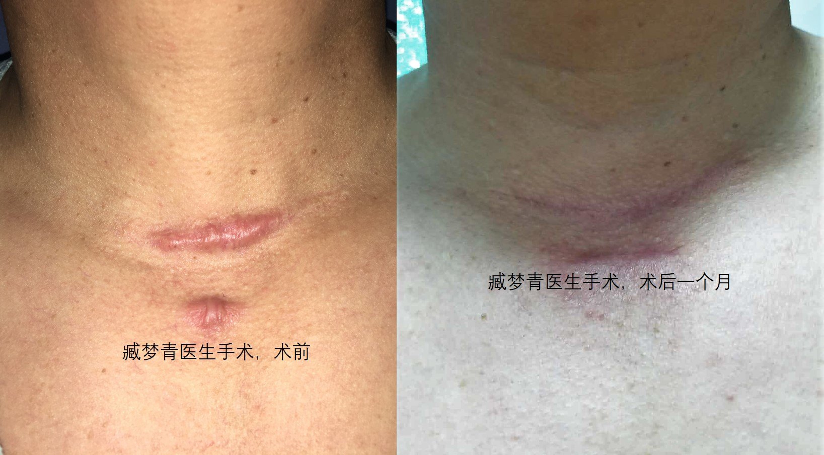 全民健身的时代手术后瘢痕增生是隐患