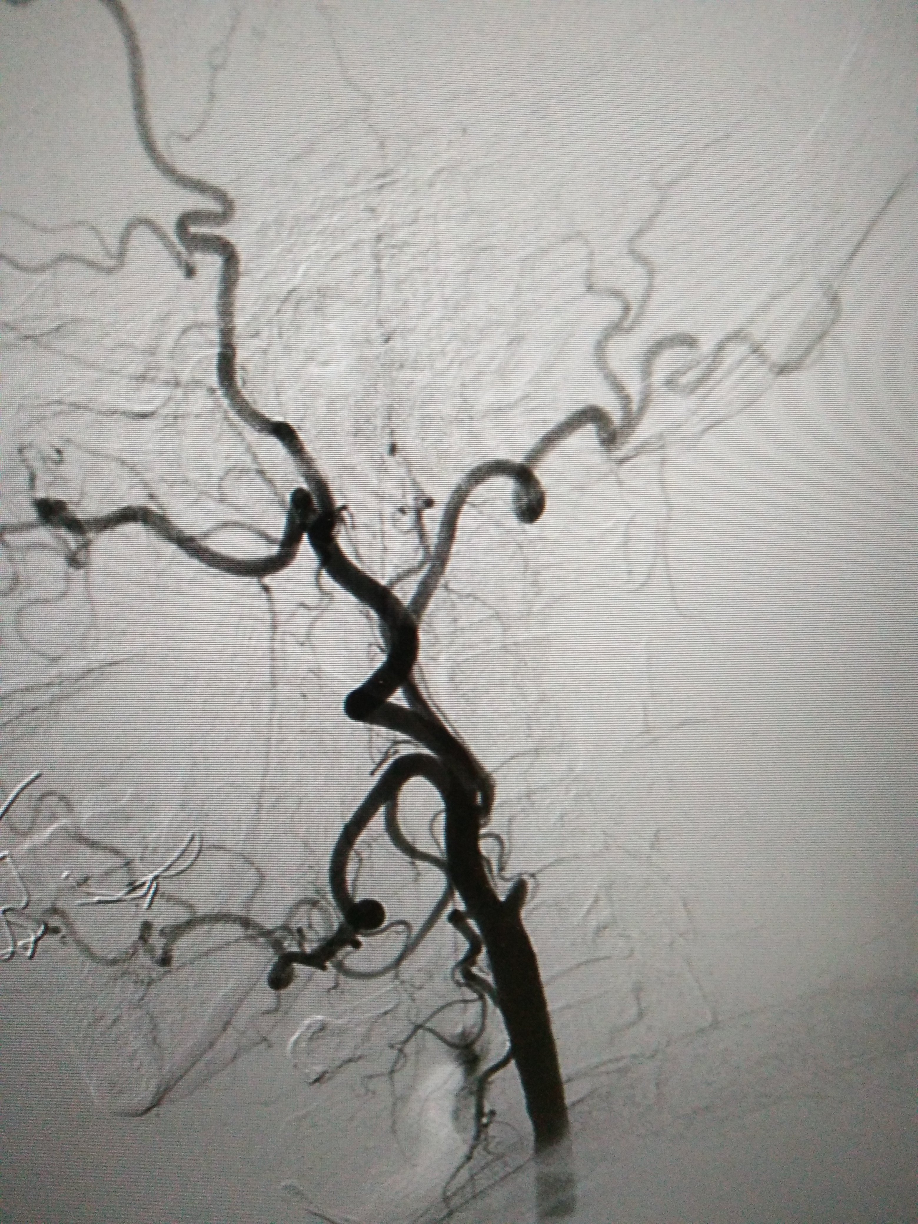 右侧颈内动脉全程闭塞(侧位)