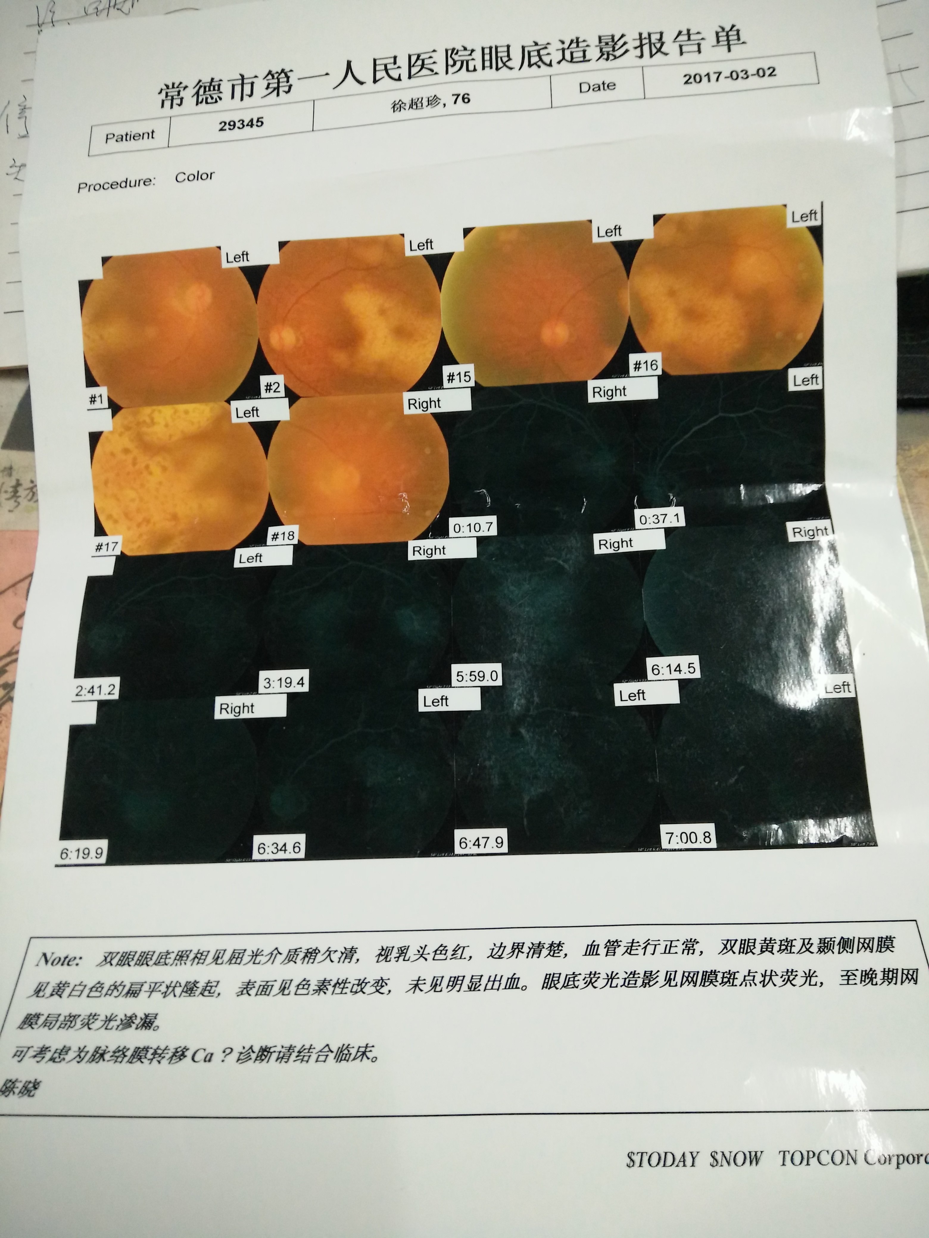 一例脉络膜转移癌患者.