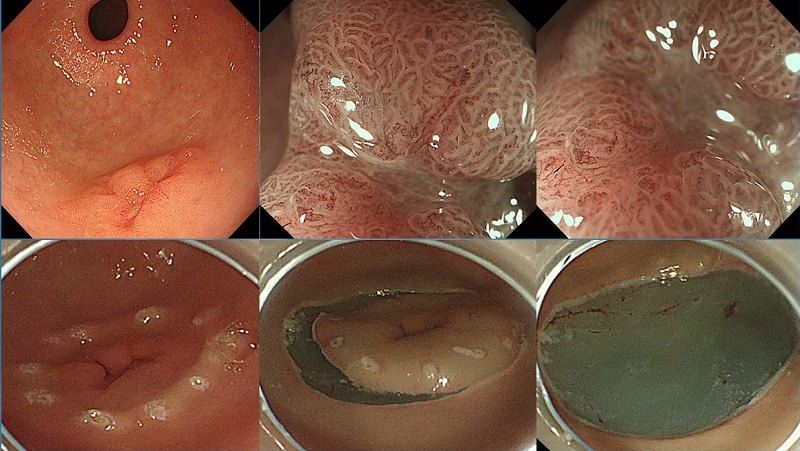 早期胃肠道 !--haodf:8:zhongliu-->肿瘤 !