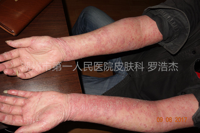 严重的银屑病红皮病患者治疗案例