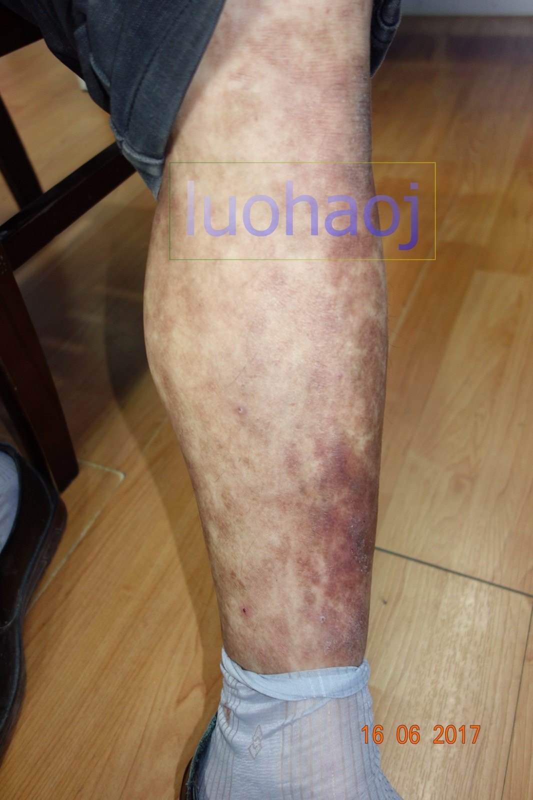 严重的双下肢小腿对称性色素紫癜样皮炎中西结合治疗医案 