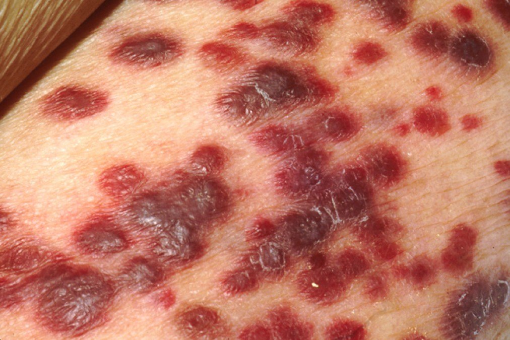 卡波西肉瘤丘疹图片