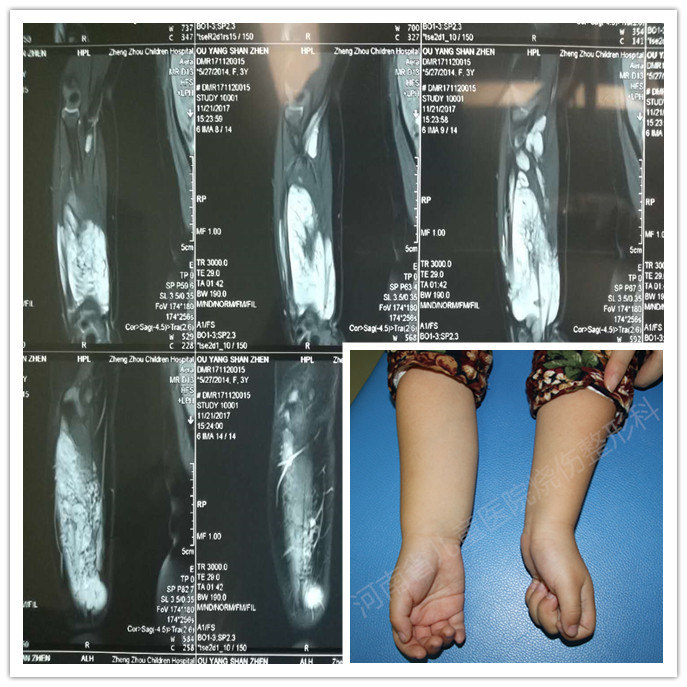 瞧这可怜的小胖胳膊原来是静脉畸形