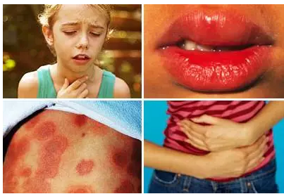 儿童严重过敏反应应怎么处理? - 好大夫在线