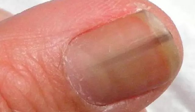 "甲乳头状瘤" 一种容易误诊的常见甲病