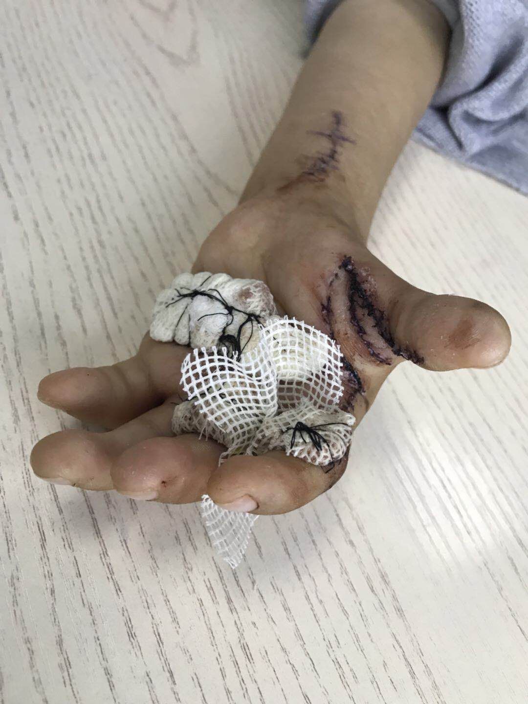 多发关节挛缩症 - 好大夫在线