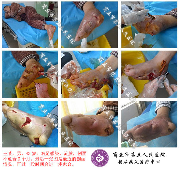 图 我院中西医结合开放疗法不截肢典型病例本文是版权所有,未经授权