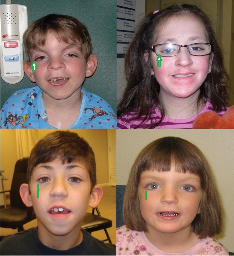 kabuki综合征歌舞伎脸谱综合征