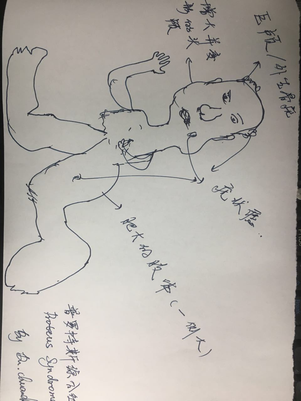 普罗特斯综合征,变形人综合征 - 好大夫在线