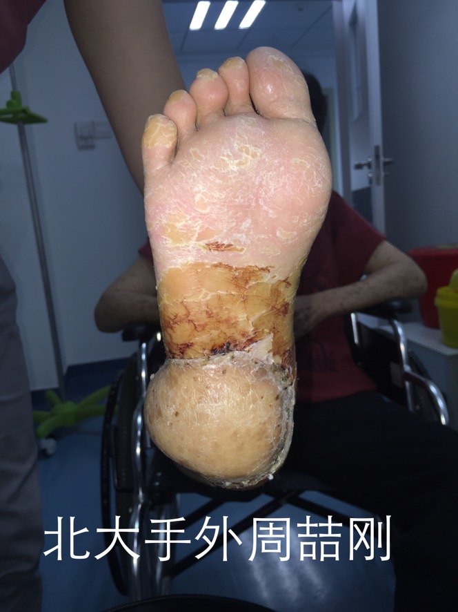足底黑色素瘤的保肢手术 有图有真相