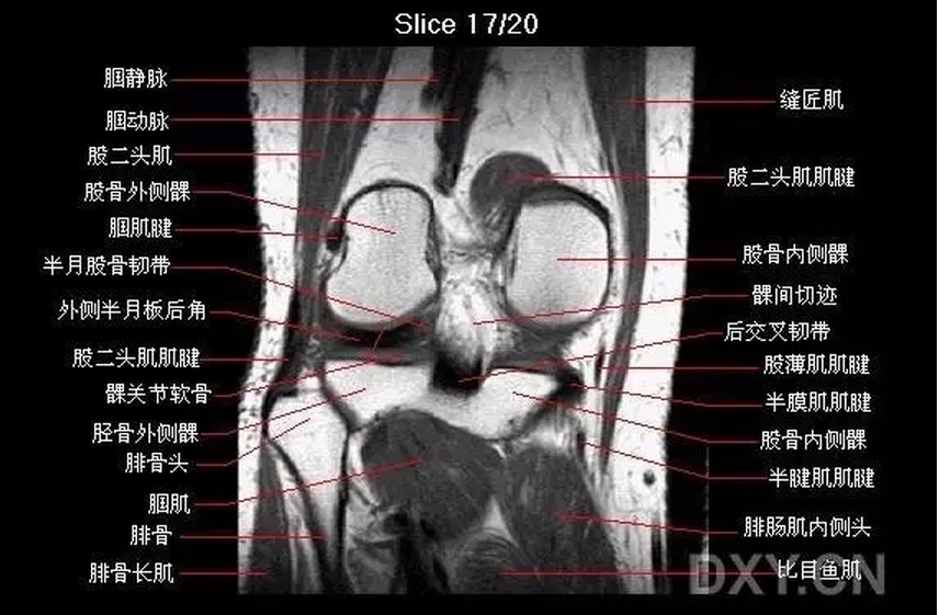 膝关节CT解剖图图片